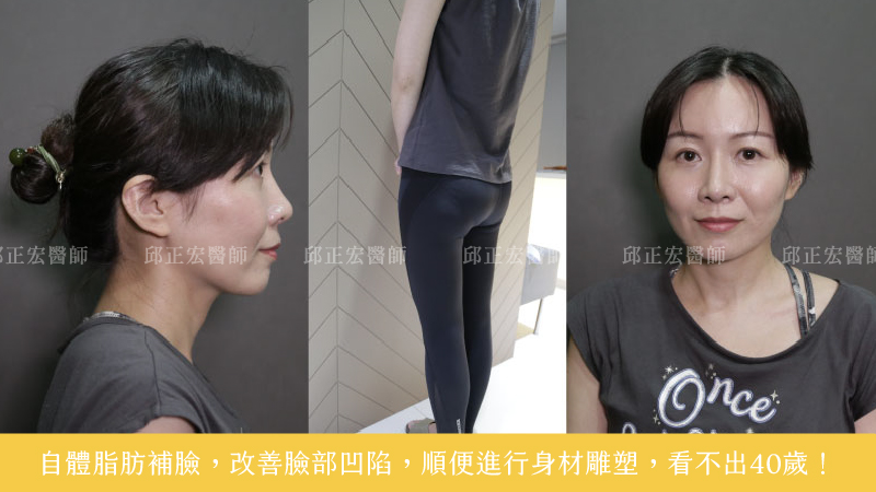 fat-transfer-case-2 fat-transfer-case-2