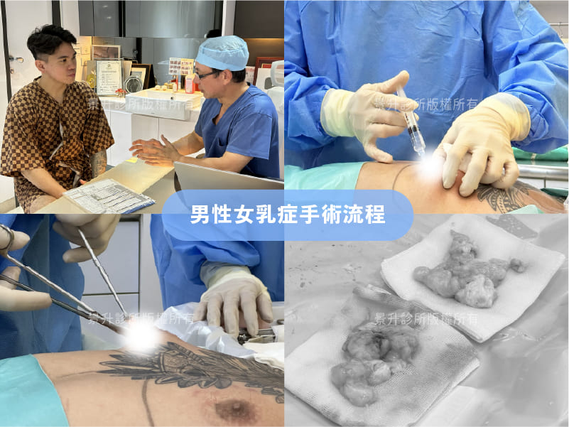 jackson-gynecomastia-caes-5