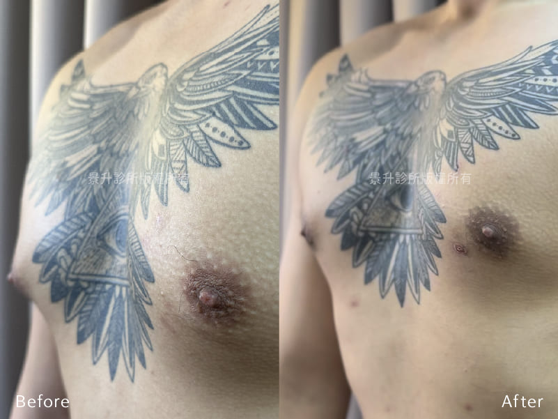 jackson-gynecomastia-caes-6