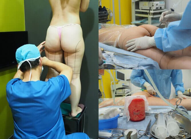 may-liposuction-story-5 may-liposuction-story-5