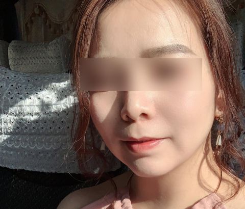 不再被照片裡的雙下巴困擾：雙下巴抽脂療程紀錄