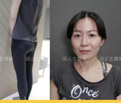 為什麼選擇微粹脂肪補臉？40+客戶回饋分享