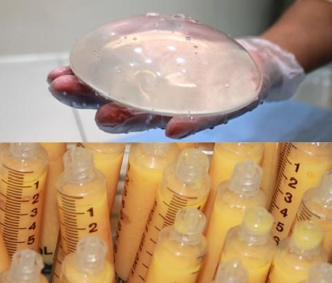 鹽水袋隆乳產生莢膜,自體脂肪隆乳重建