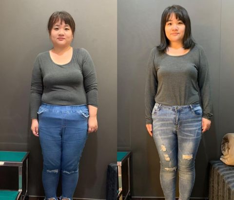 胃肉毒減重案例：療程評估、飲食調整與過程紀錄