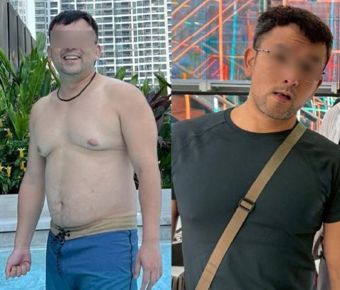 胃肉毒減重有效嗎?我從100公斤開始的減重改變