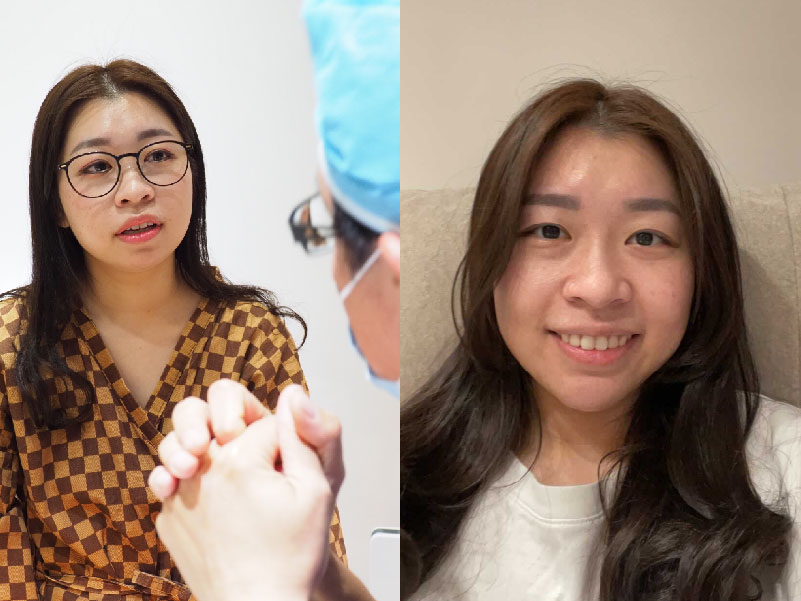 自體脂肪補下巴