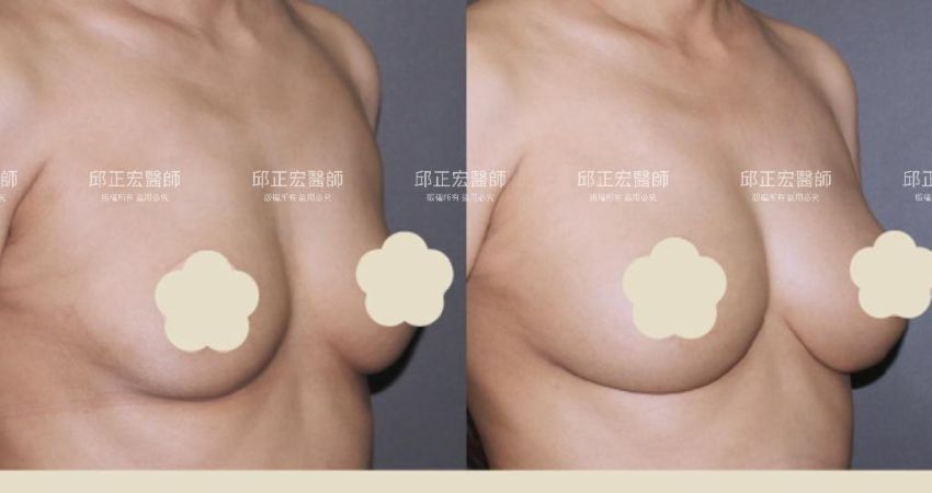 上胸塌陷－>整體飽滿