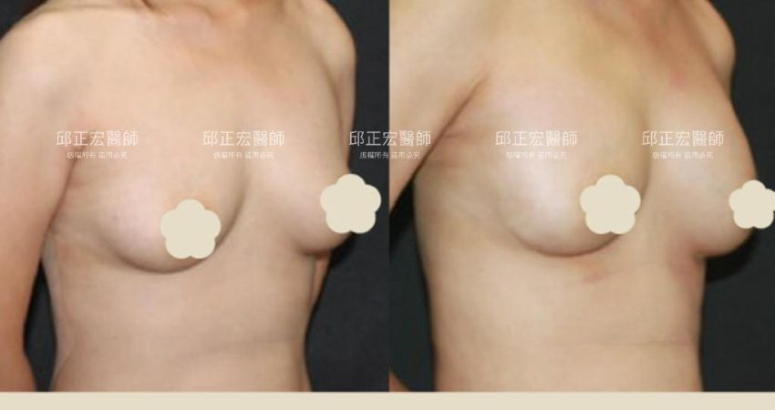 產後鬆垂－>重心上提