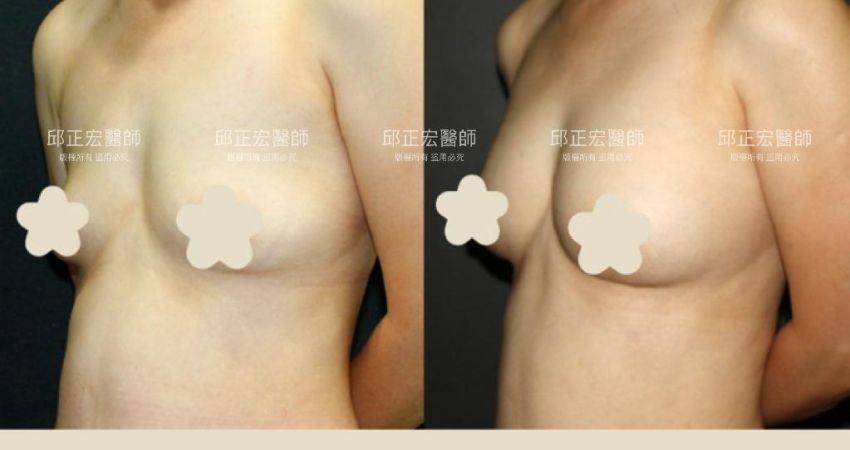 胸型外散－>集中穩定