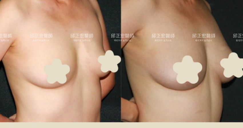 上胸凹陷－>平滑曲線