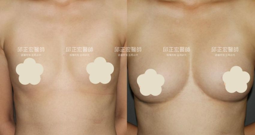 內側無肉－>內緣有型