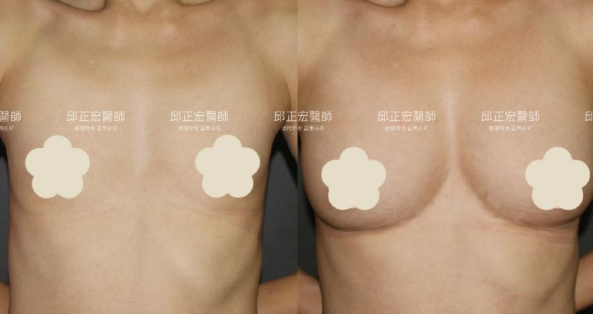 中線空白－>胸型立體