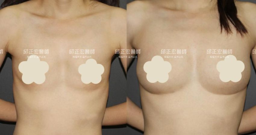 胸前單薄－>自然曲線