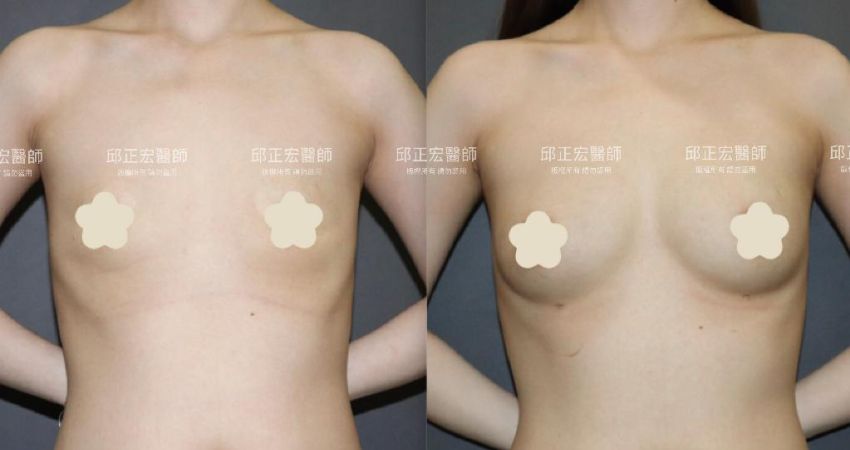 胸型平面－>輪廓浮現