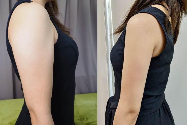 手臂抽脂完整介紹|效果與術後照護,抽脂前必看!