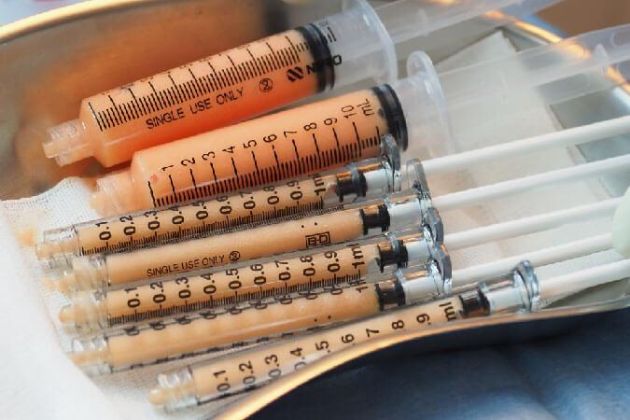 自體脂肪移植是什麼？