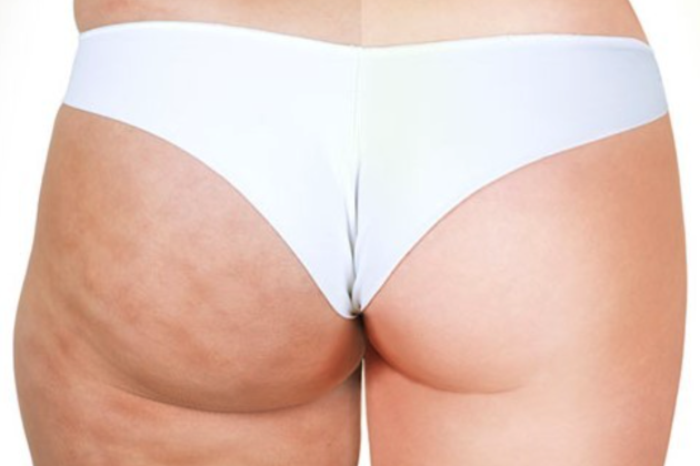 橘皮組織怎麼消不掉?了解形成原因與改善方式